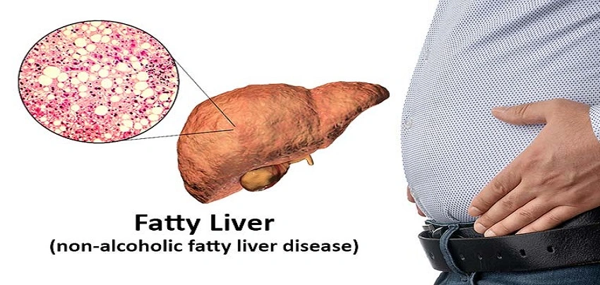 Fatty Liver