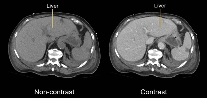 CT scan of the abdomen with contrast