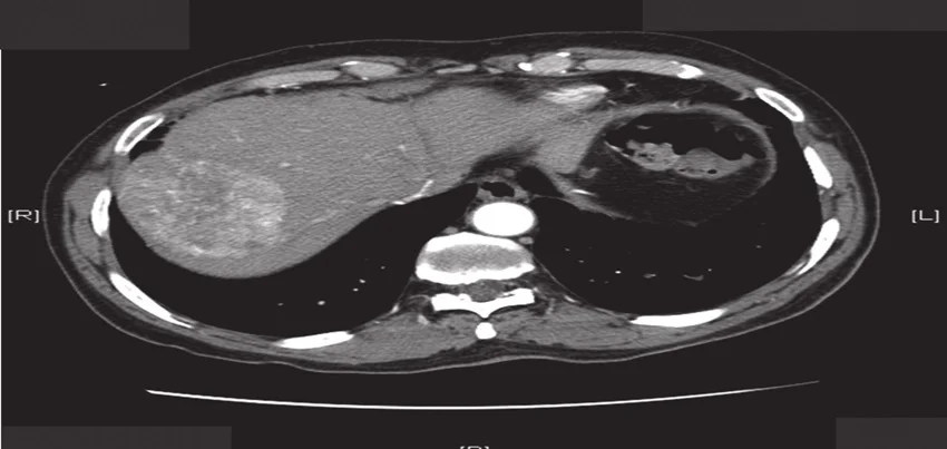CT scan of the abdomen triphasic liver