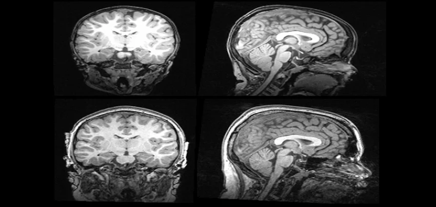 MRI of the brain