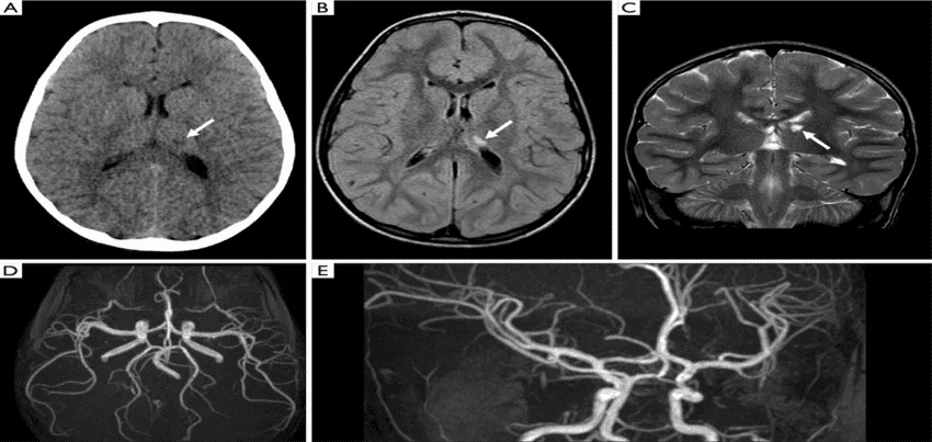 MRI Angiograpy Of Brain or MRA of Brain