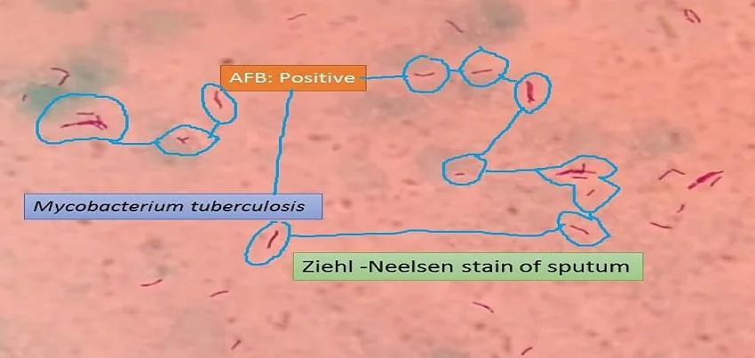 Sputum AFB (Acid-fast bacilli) Test