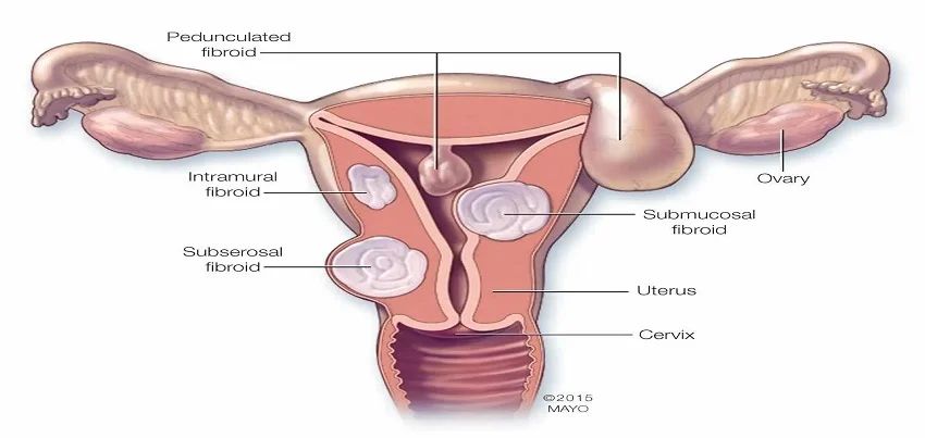 Fibroids reproductive system