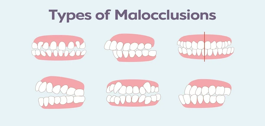 Malocclusion