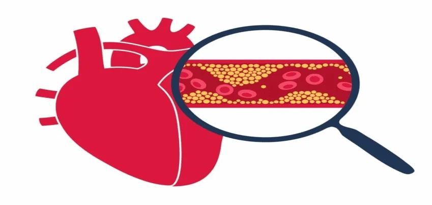 Lipoprotein (a) Test