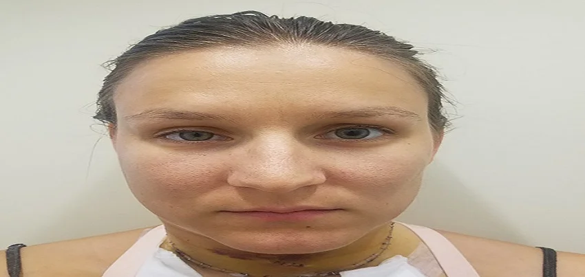 Horner Syndrome