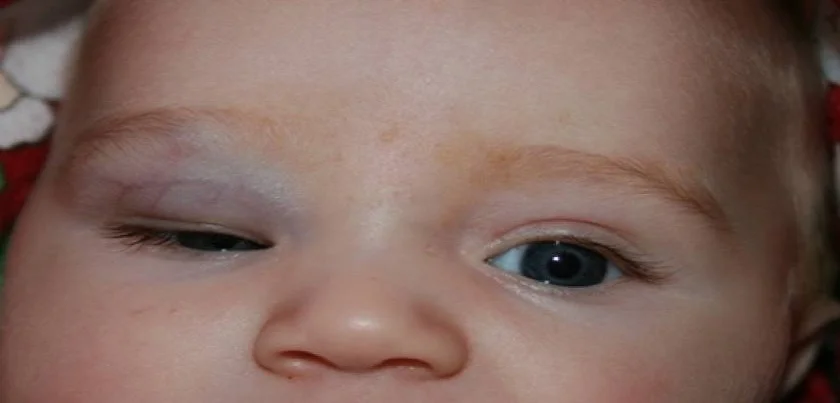 Congenital capillary haemangioma of the eyelid