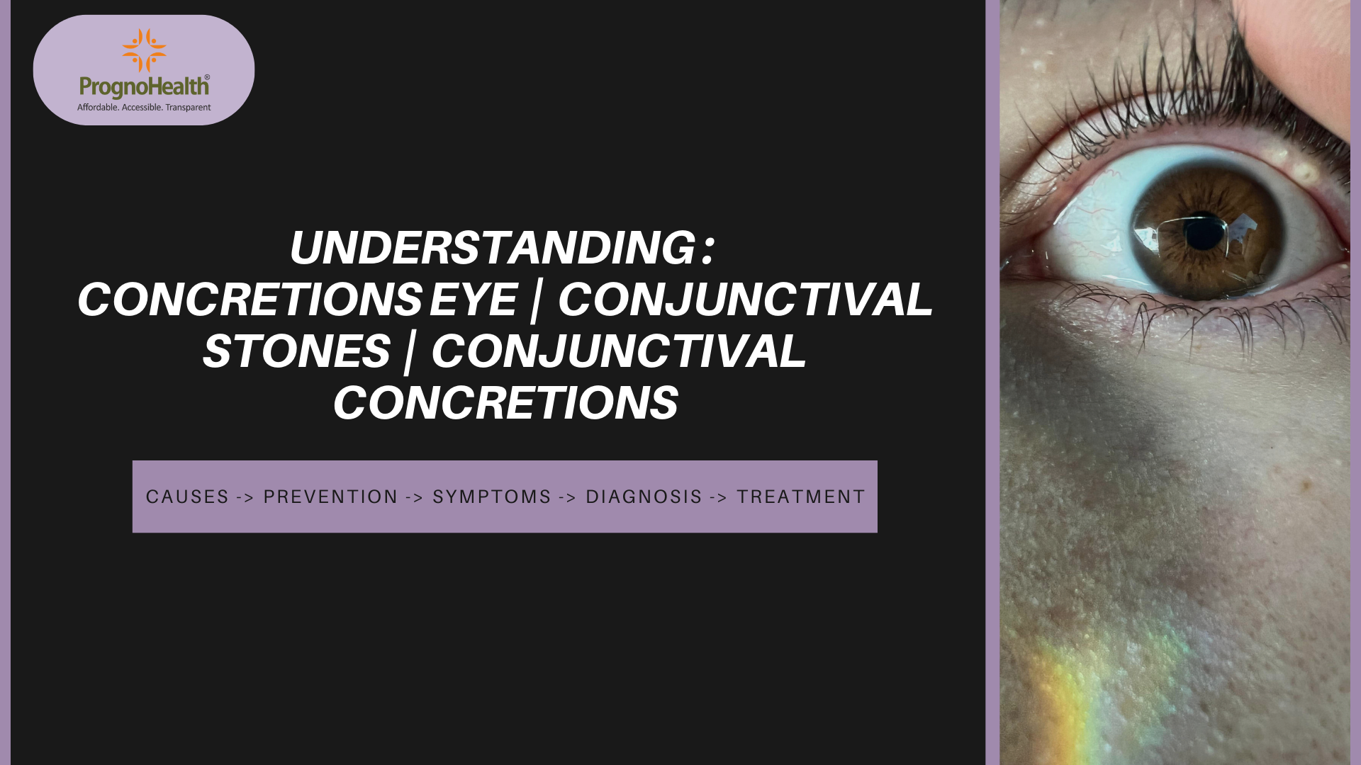 Conjunctival concretions