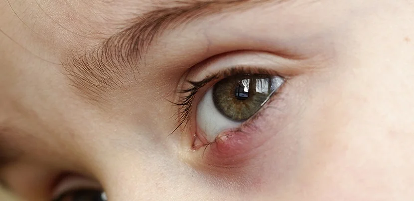 Chalazion