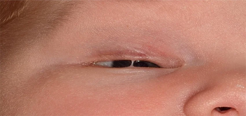 Ankyloblepharon