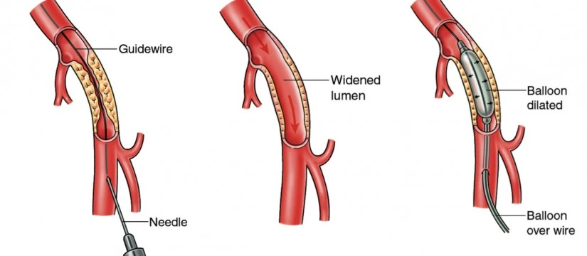 Angio Peripheral