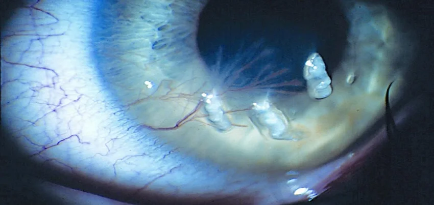 Filamentary