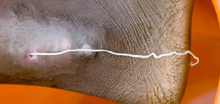 Dracunculiasis