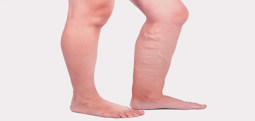 Filariasis