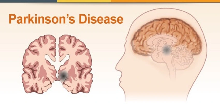 Parkinson’s disease (PD)