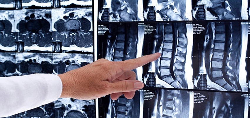 MRI of the Lumbar and Sacral Spine