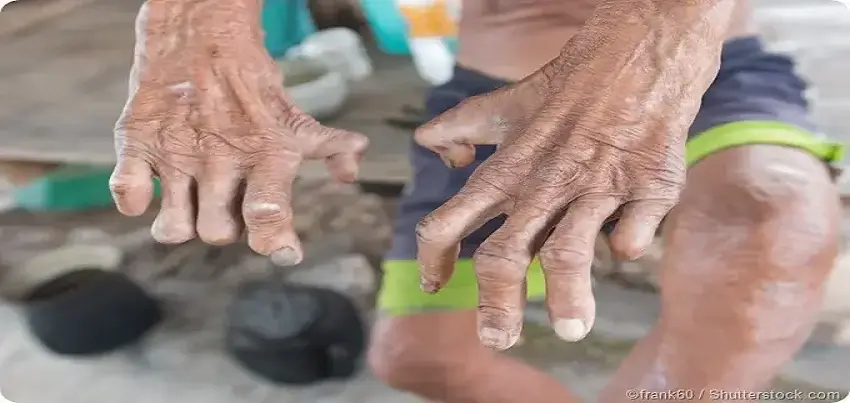 Leprosy