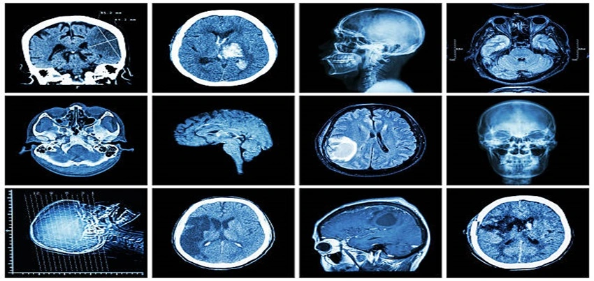 CT scan Spiral Angio Brain