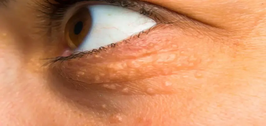 Xanthelasma