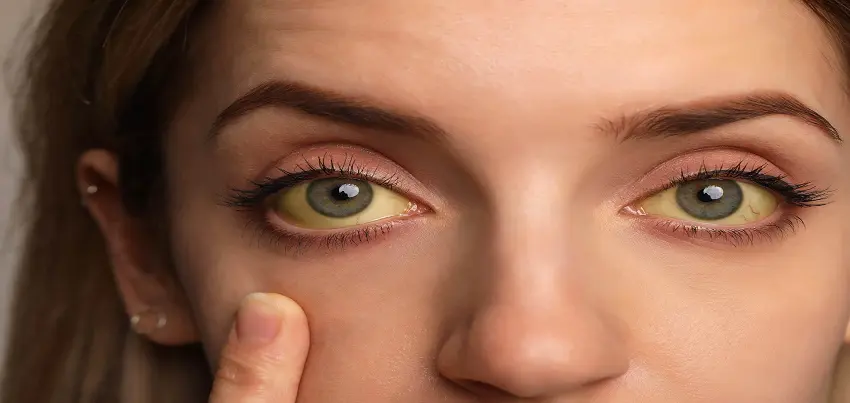 Yellow fever