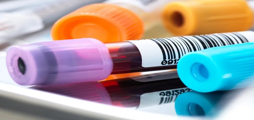 Adult Hemoglobin Electrophoresis (Hb-Elec) Test