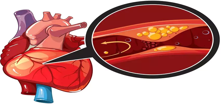 Coronary heart disease