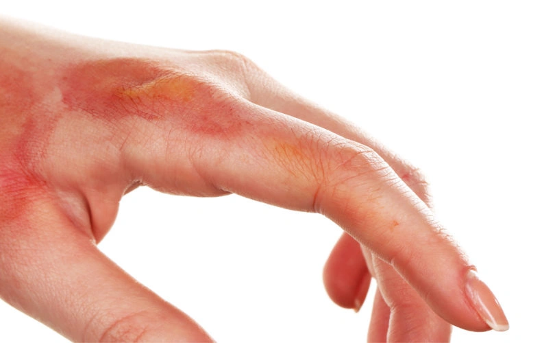 Chemical injuries