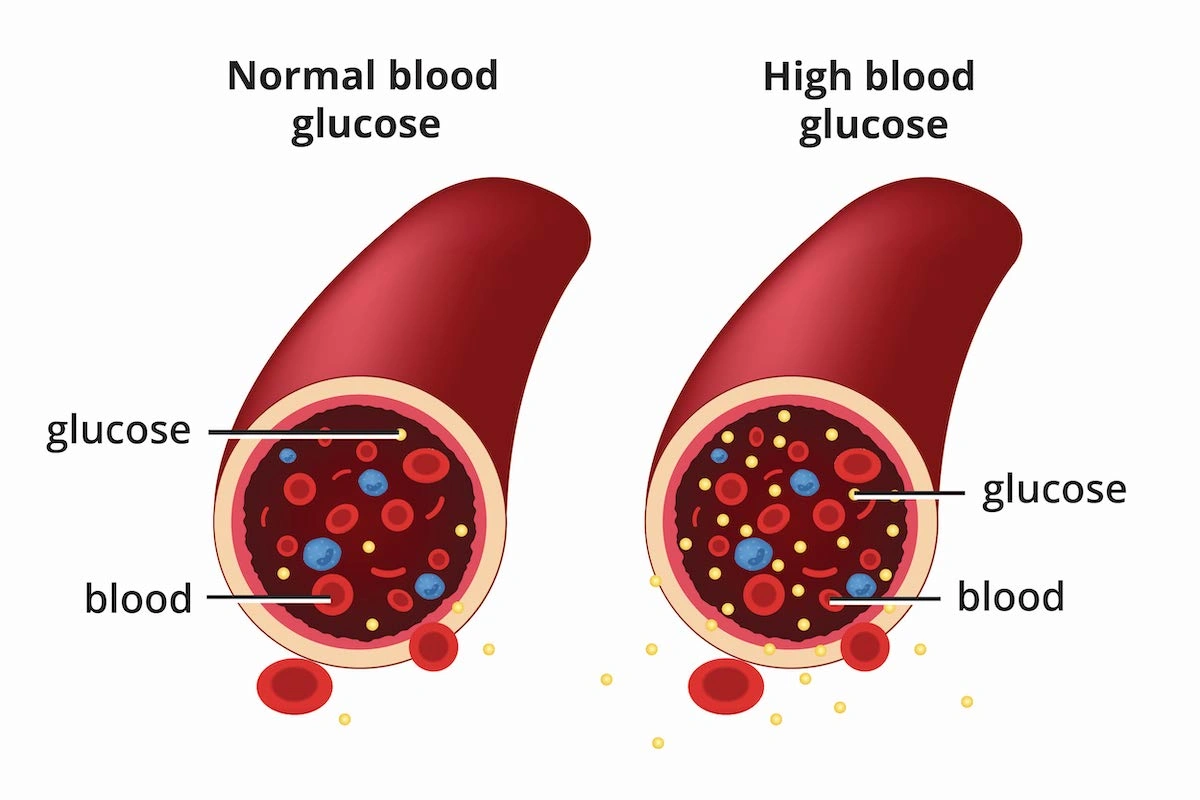 Diabetes