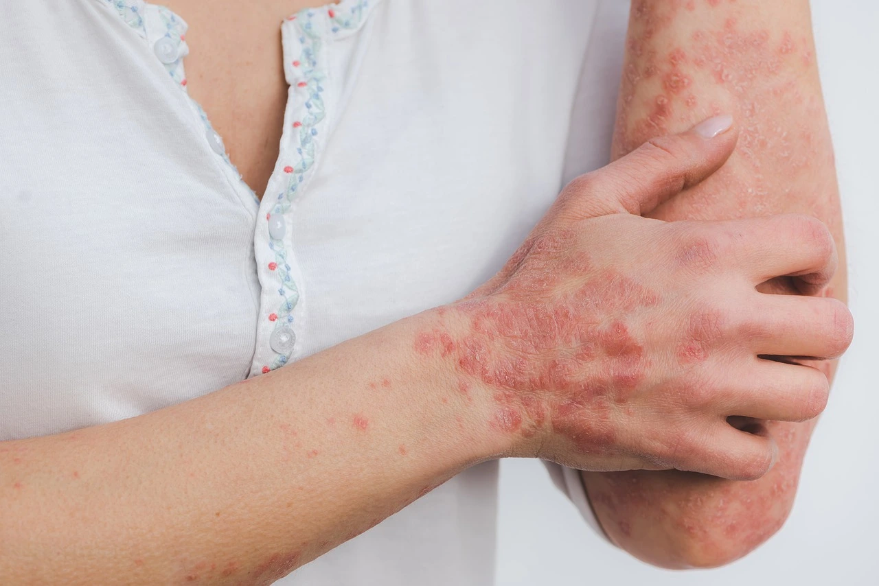 Understanding Psoriasis and 4 simple Tips to Beat It