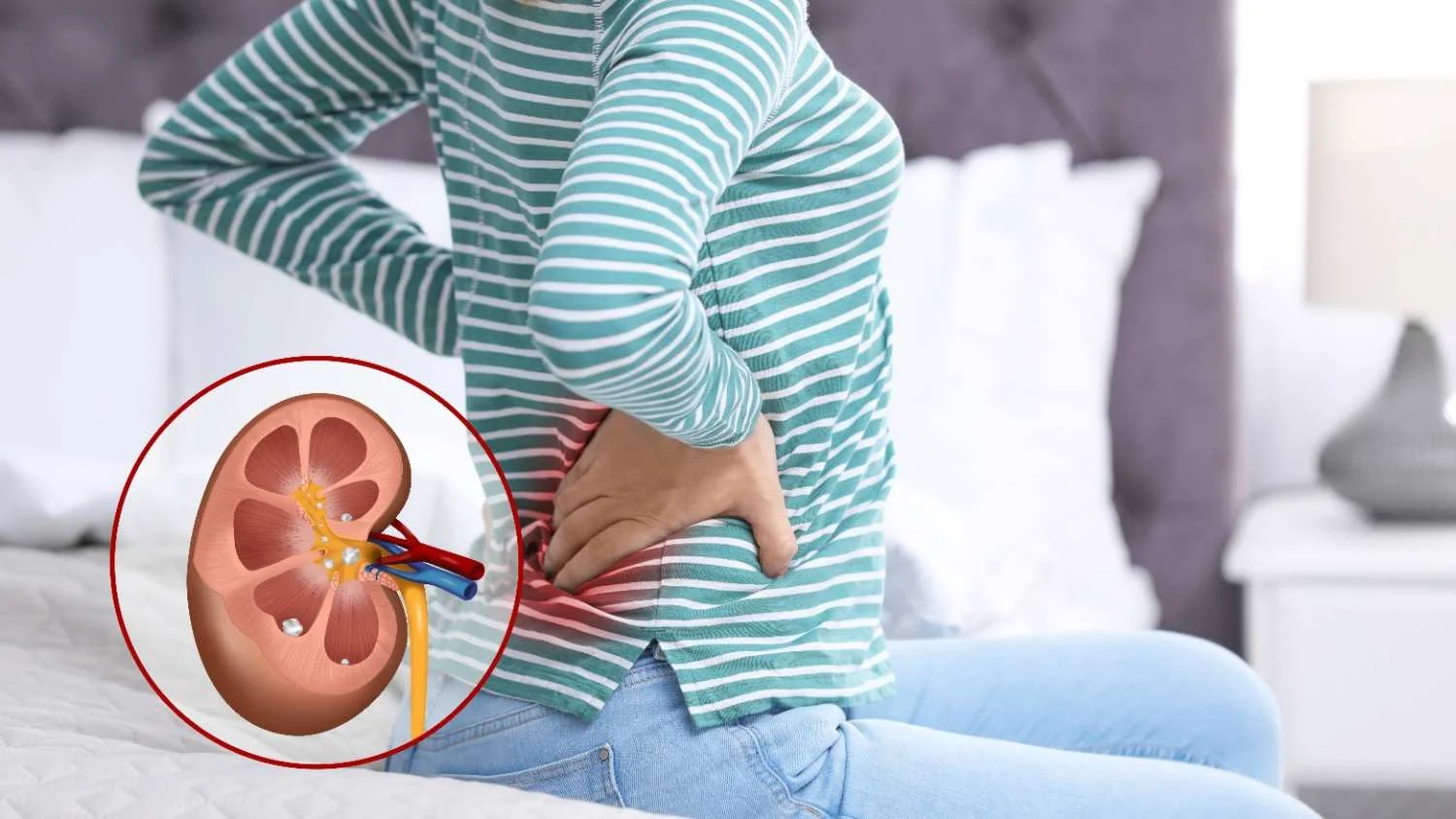 Kidney Stones