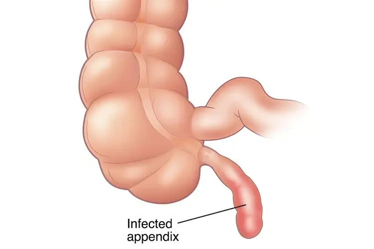 Appendicitis: Types, Symptoms, Prevention and Treatment