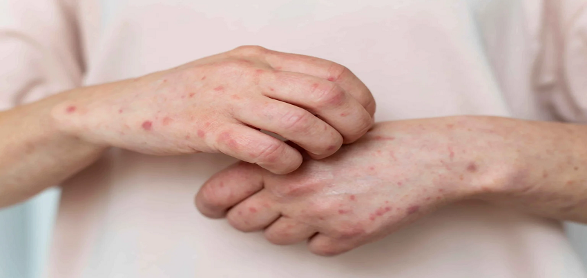 Common Skin Diseases in India