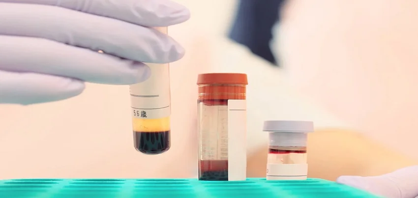 Protein electrophoresis Test
