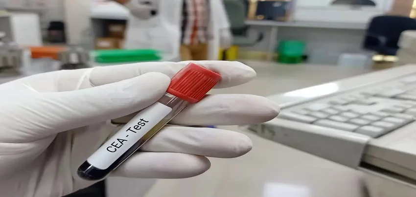 Carcino Embryonic Antigen (CEA) Test