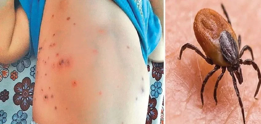 Scrub typhus