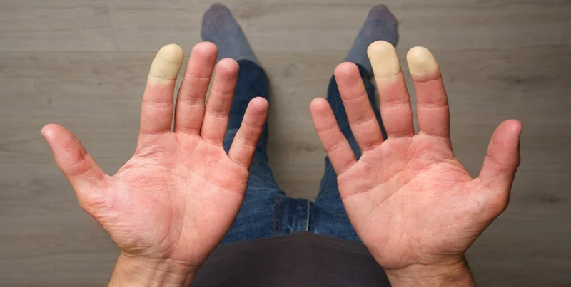 Raynaud’s phenomenon