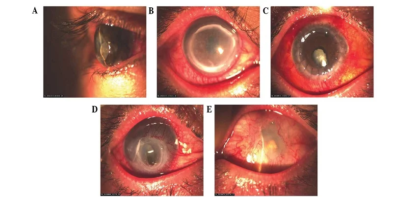 Mooren’s ulcer