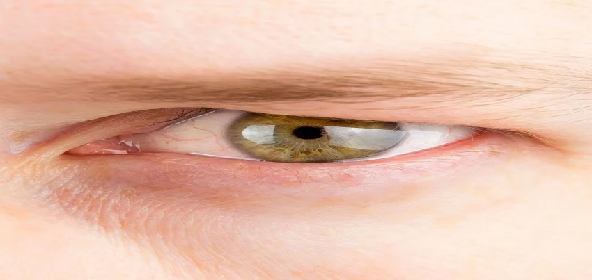 Dermatochalasis