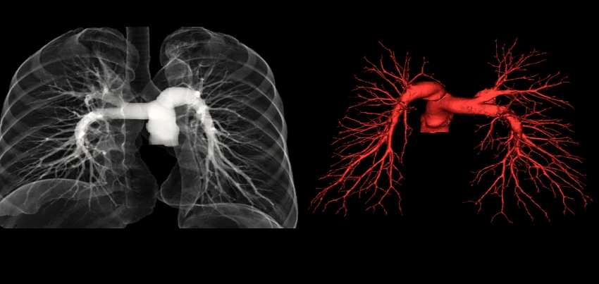 Angio Pulmonary