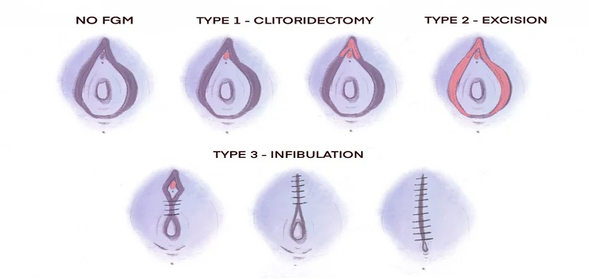 Female genital mutilation (FGM)