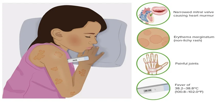 Rheumatic fever