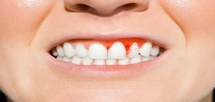 Gum disease
