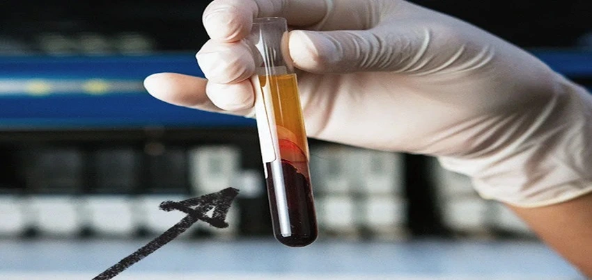 C-Peptide Test