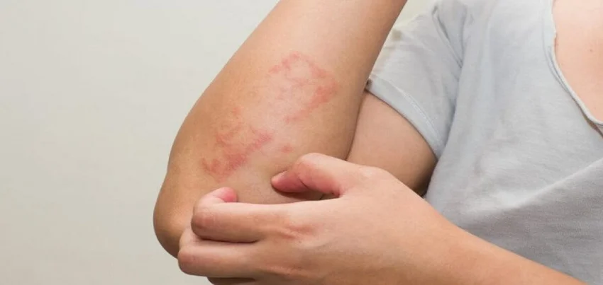 Lichen planus