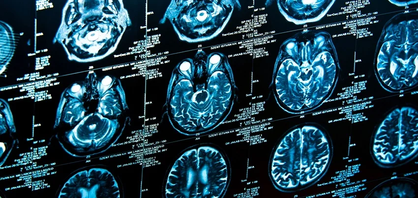 CT Scan Brain: