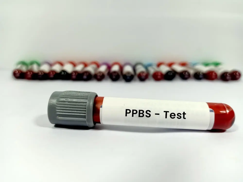 Blood Sugar Post Prandial Test