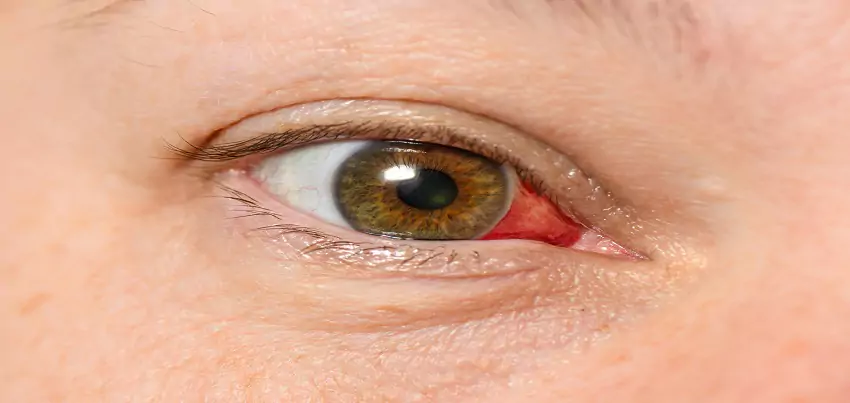 Corneal abrasion     