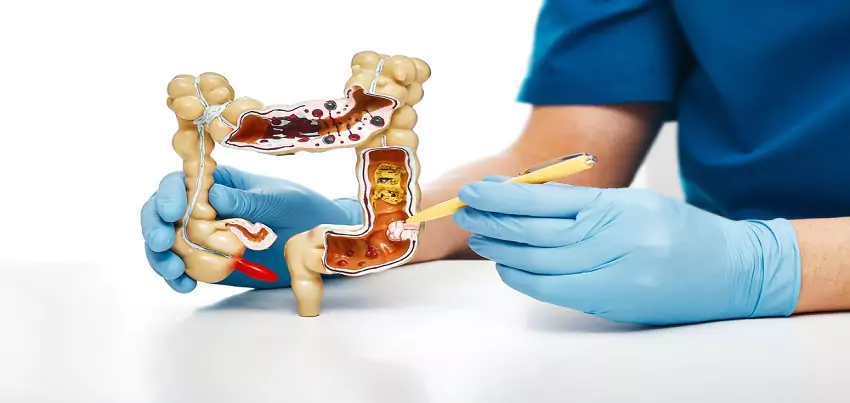 Colorectal cancer