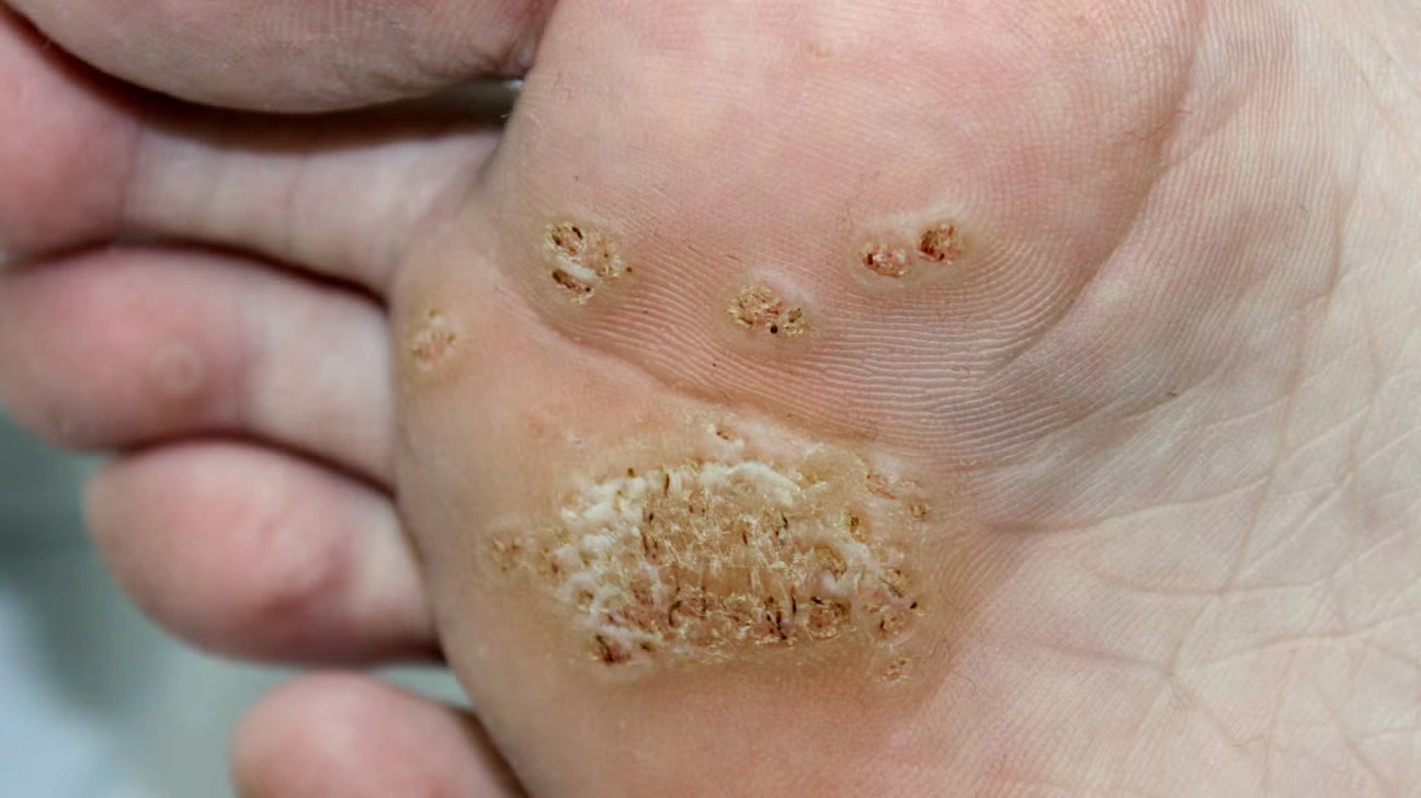 Warts