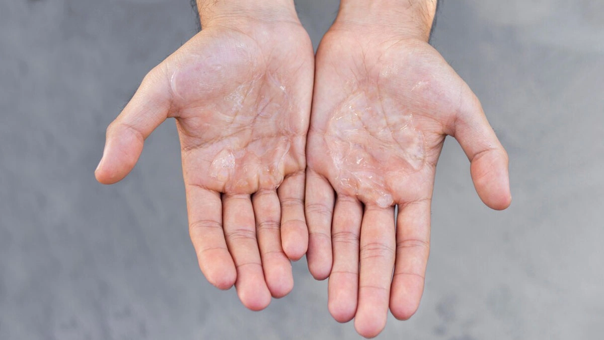 Hyperhidrosis